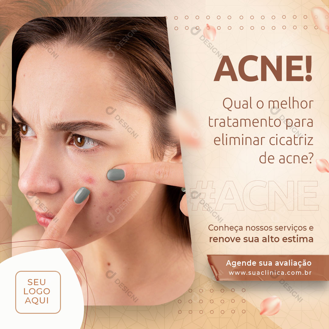 Tratamento Para Eliminar Cicatriz De ACNE Social Media PSD Editável