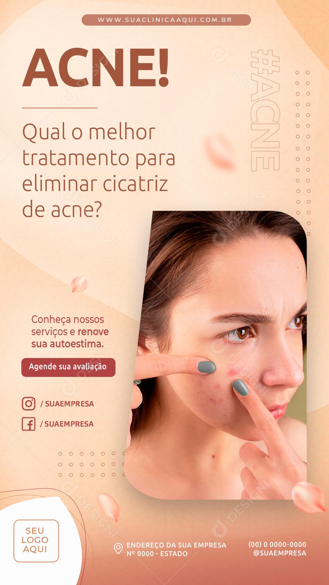 Qual o Melhor Tratamento Para Eliminar O ACNE Social Media PSD Editável