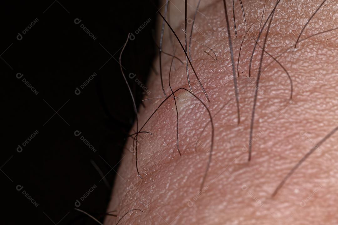 Inflamação causada por pêlos encravados no dedão do pé em visão macro