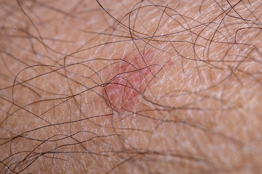 Irritação vermelha na pele caucasiana causada por uma picada de inseto