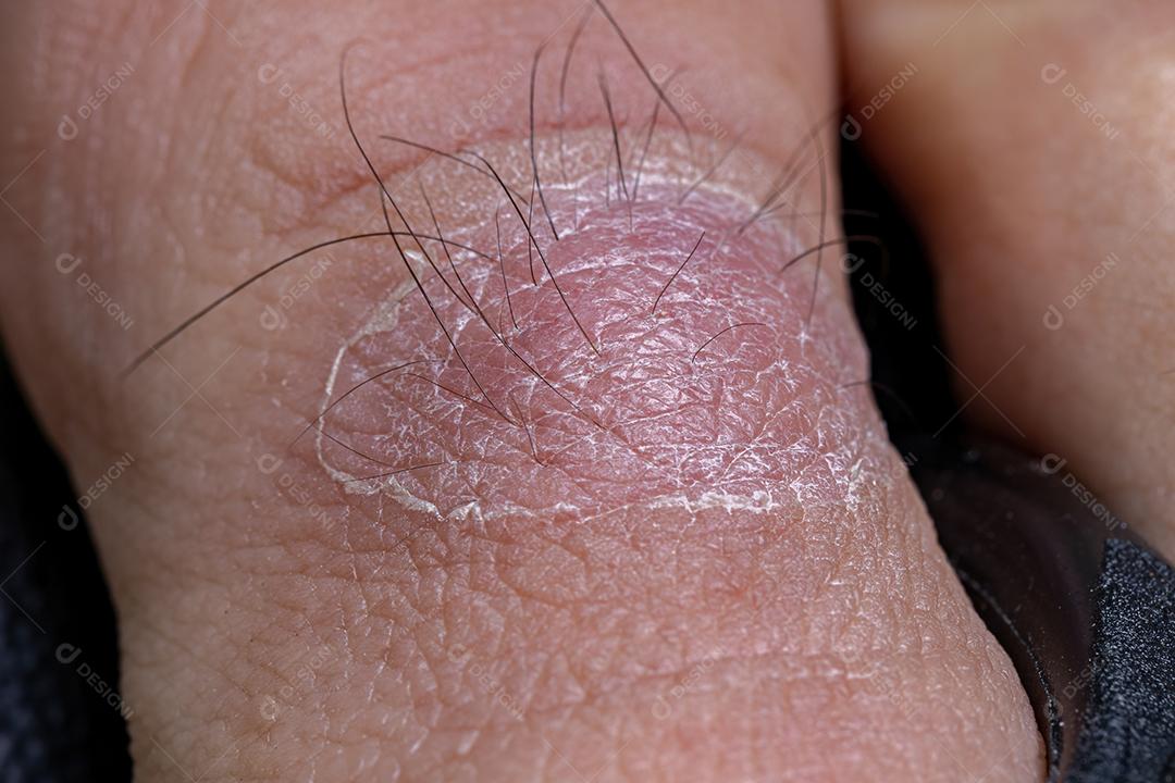 Processo de cicatrização da pele no dedão do pé após inflamação de pêlos encravados