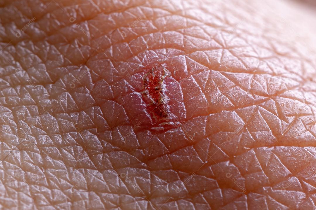 Processo de cicatrização da pele caucasiana de uma micro ferida em visão macro