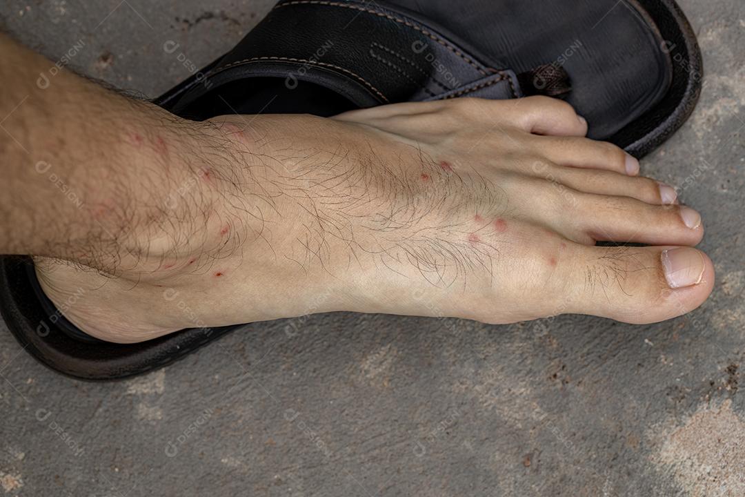 reações alérgicas a picadas de carrapato