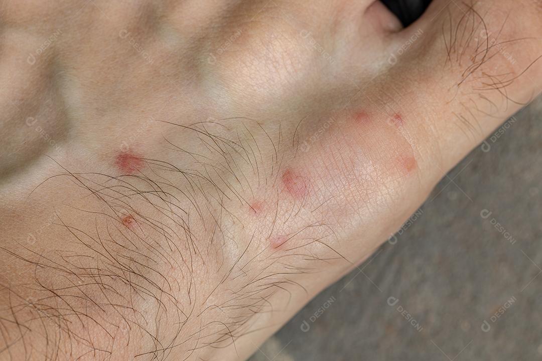 reações alérgicas a picadas de carrapato