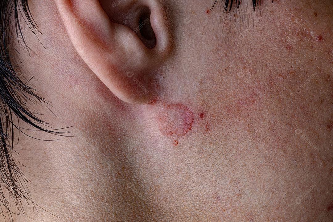Dermatite Danos na Pele Imagem JPG