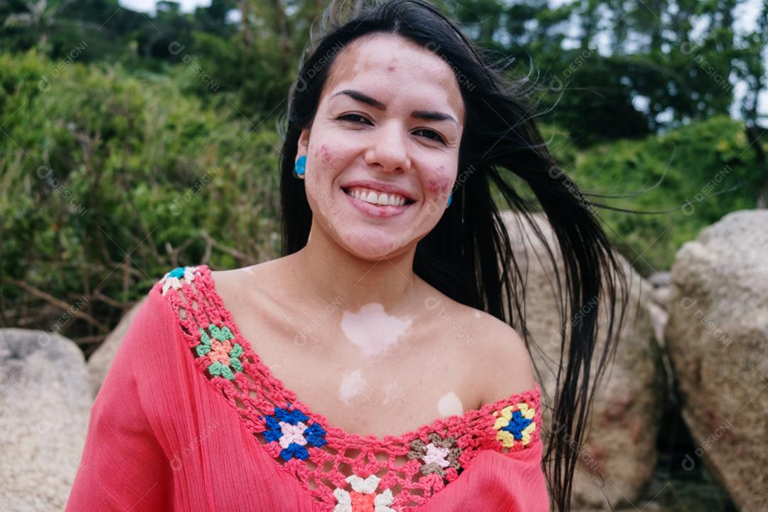 Linda garota latina com vitiligo na praia. Dia Mundial do Vitiligo. Distúrbios de pigmentação