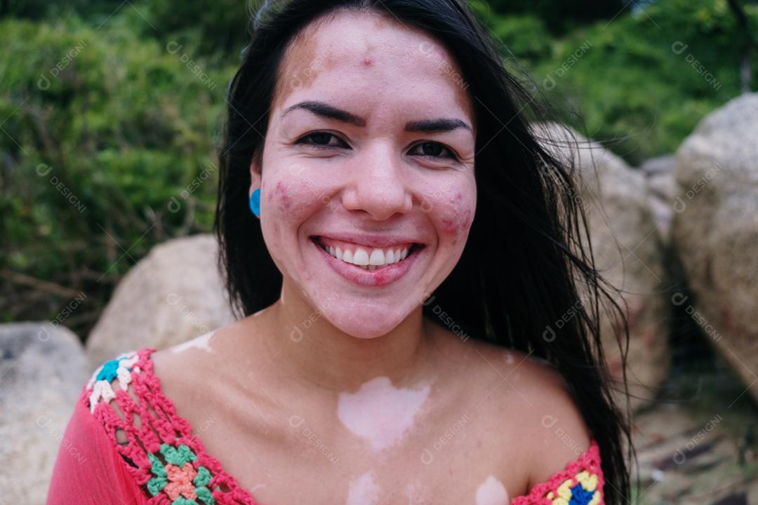 Linda garota latina com vitiligo na praia. Dia Mundial do Vitiligo. Distúrbios de pigmentação