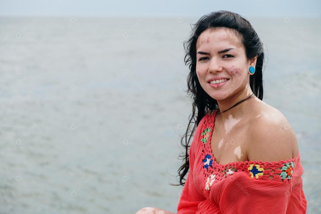 Linda garota latina com vitiligo na praia. Dia Mundial do Vitiligo. Distúrbios de pigmentação