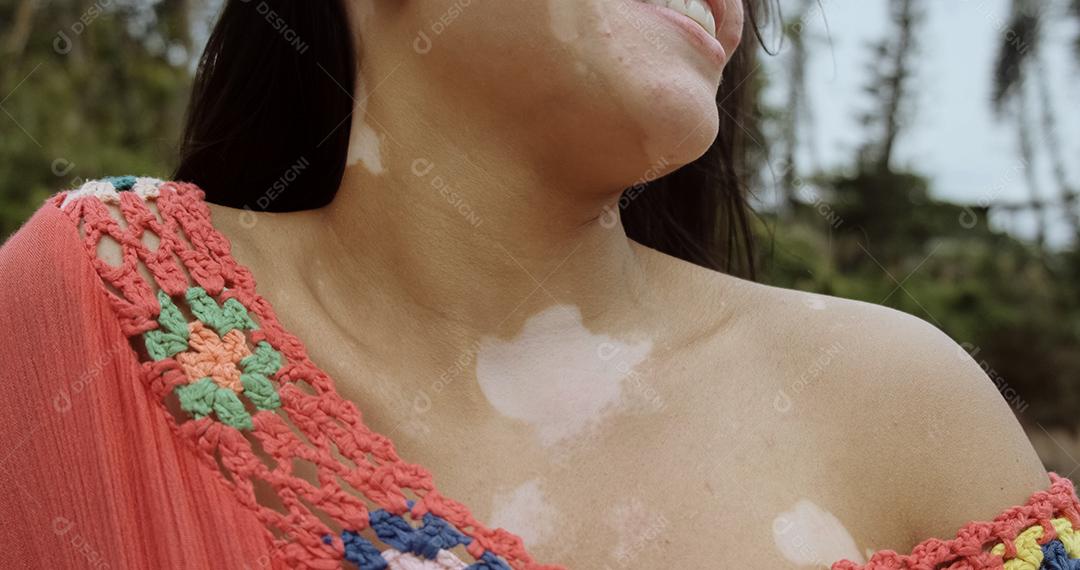 Linda garota latina com vitiligo na praia. Vitiligo Mundial