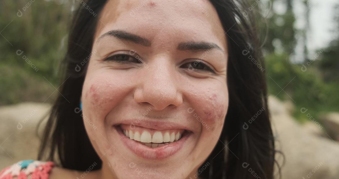 Linda garota latina com vitiligo na praia. Vitiligo Mundial
