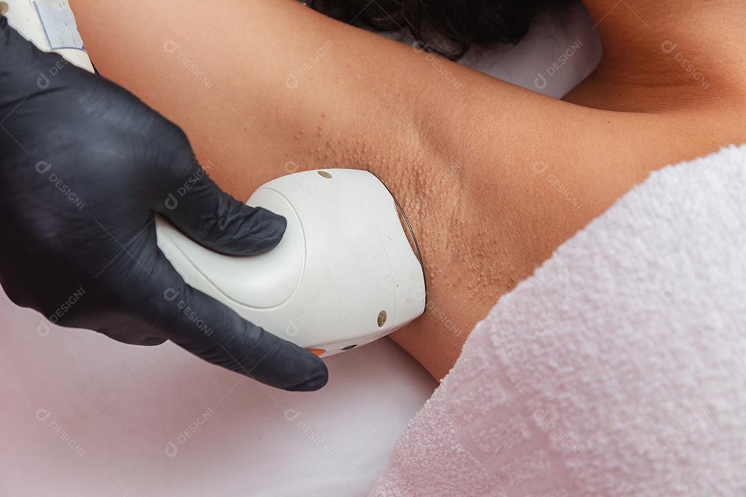 Mulher morena brasileira realizando depilação a laser nas axilas