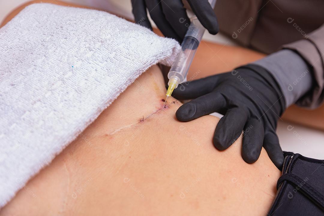 procedimento de cura estética usando ozônio. Mulher aplicando ozônio após cirurgia plástica para acelerar o processo de cicatrização