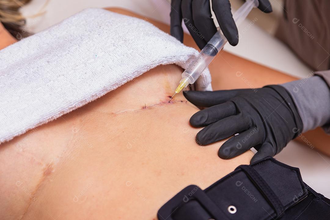 procedimento de cura estética usando ozônio. Mulher aplicando ozônio após cirurgia plástica para acelerar o processo de cicatrização