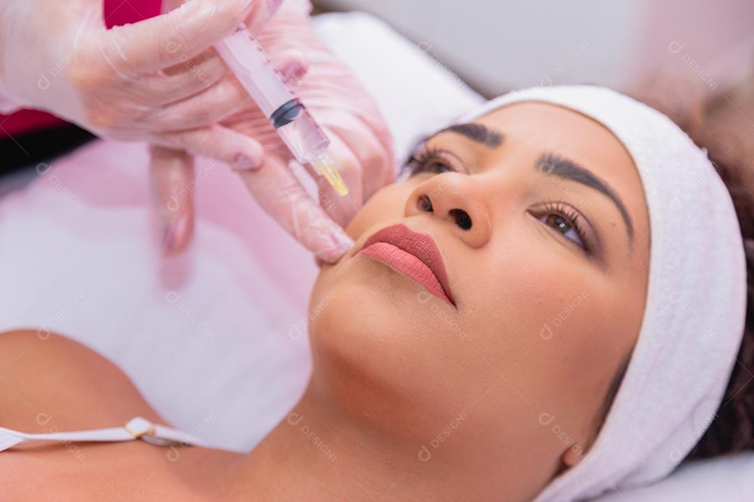 Aplicação de ácido hialurônico e enzimas no bigode japonês no rosto da jovem para tratamento estético.