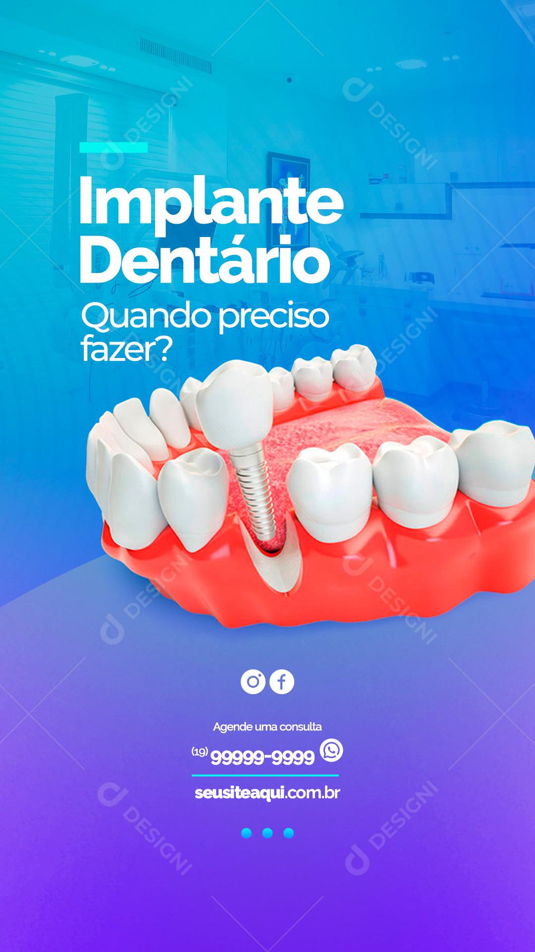 Story Implante Dentário Quando preciso fazer Dentista Social Media PSD Editável