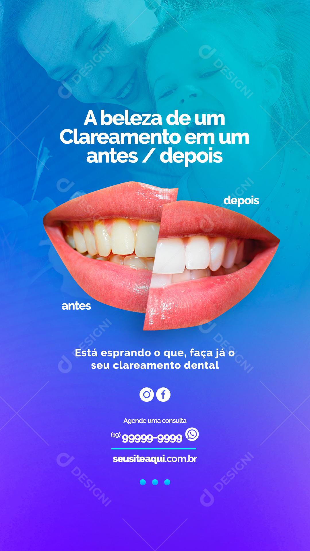 Story A Beleza de um Clareamente em um antes depois Dentista Social Media PSD Editável