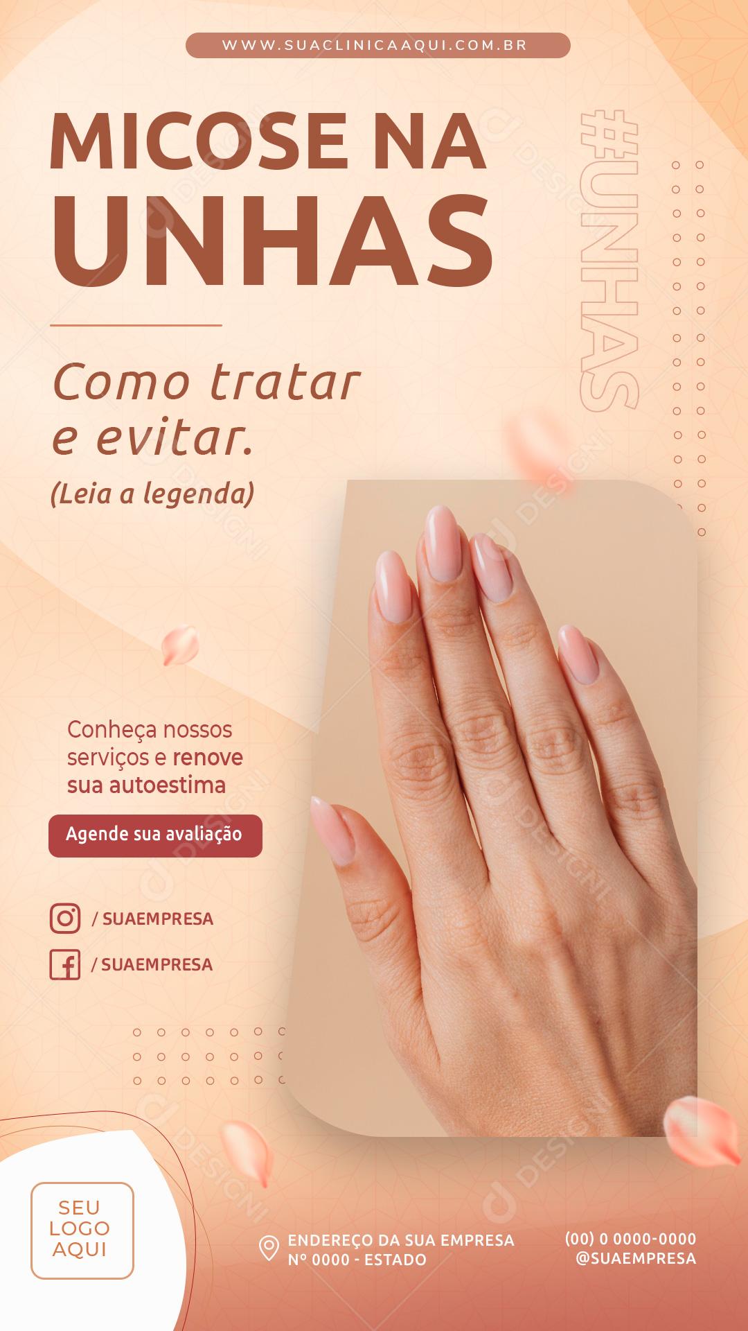 Social Media Story Manicure Micose na unhas PSD Editável