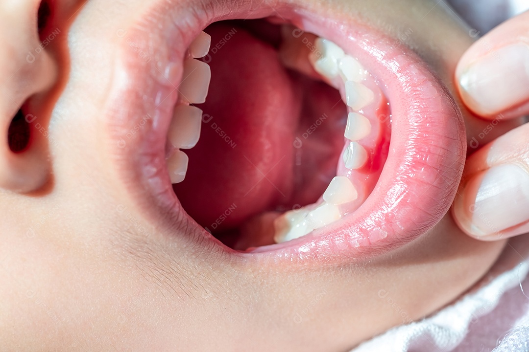 A menina abriu a boca para verificar o sangue causado pelos dentes de leite soltos. conceito de atendimento bucal e odontológico