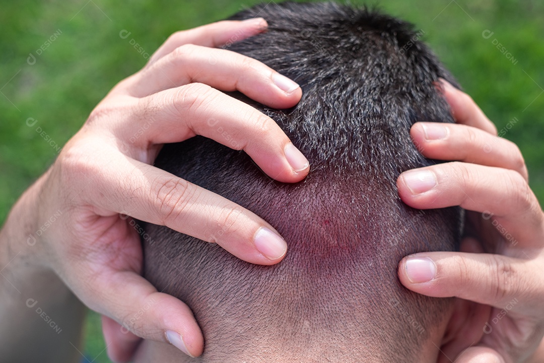 Homem segurando a cabeça com as duas mãos por causa da dor causada por uma picada de vespa ou abelha