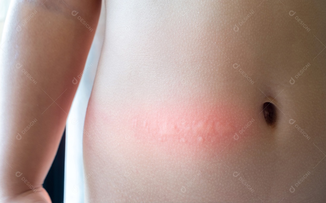 Cintura do bebê com erupção cutânea e alergia com mancha vermelha causada por picada de mosquito,