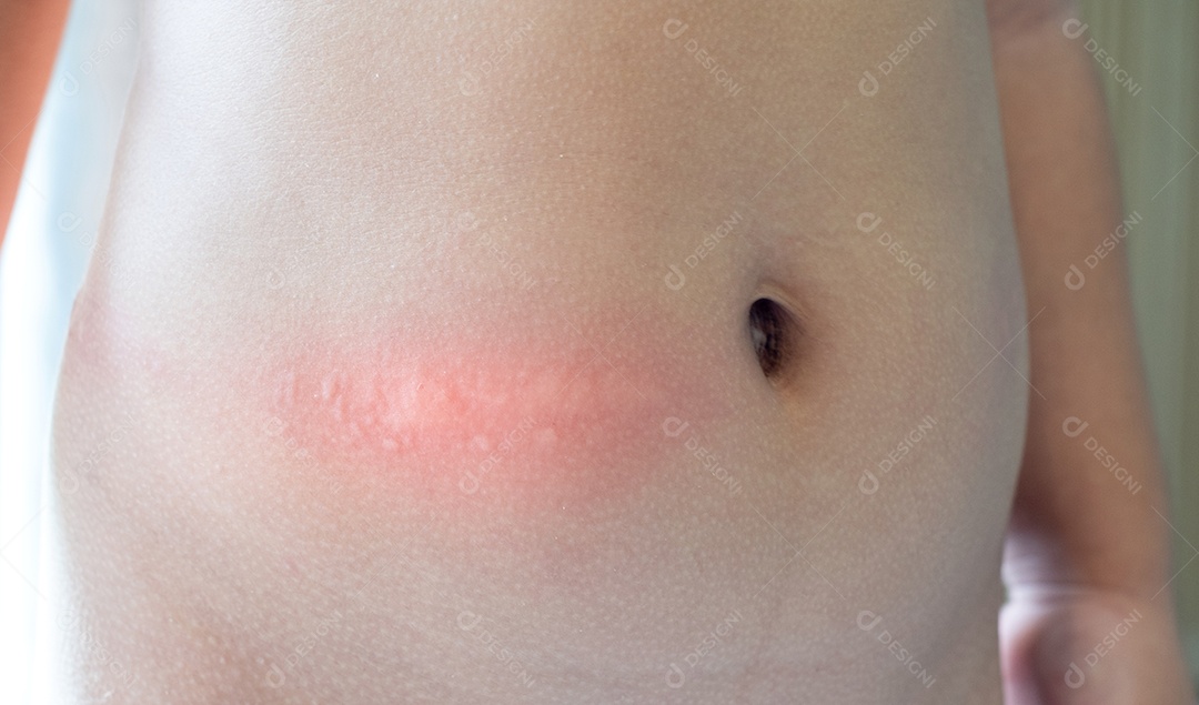 Cintura do bebê com erupção cutânea e alergia com mancha vermelha causada por picada de mosquito,