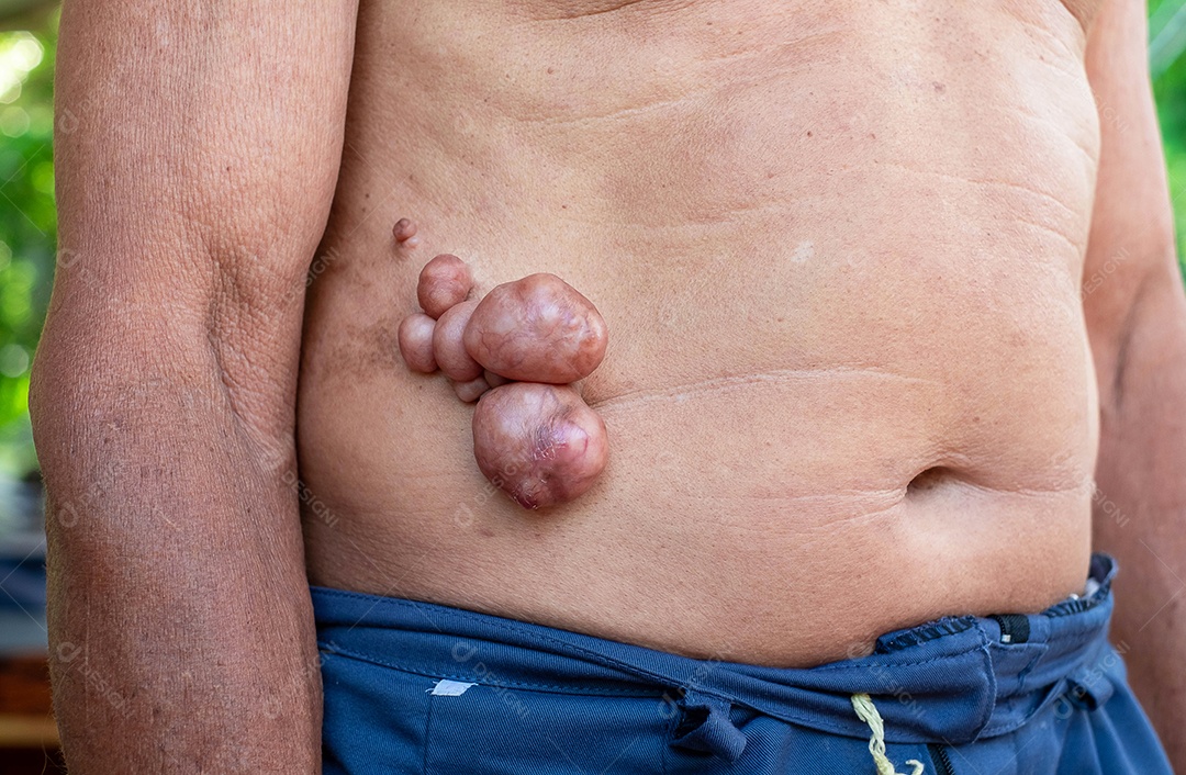 Pólipos grandes, área lateral, crescem de tamanho com o tempo, sem dor.