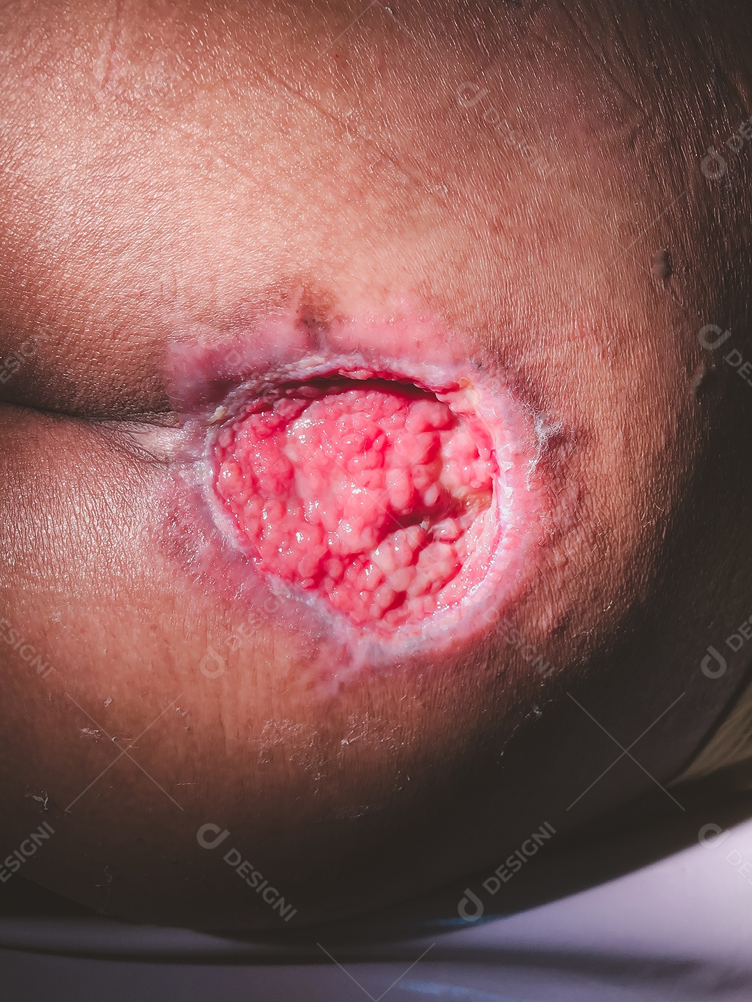 Lesão por pressão estágio IV Escara de pressão acamada