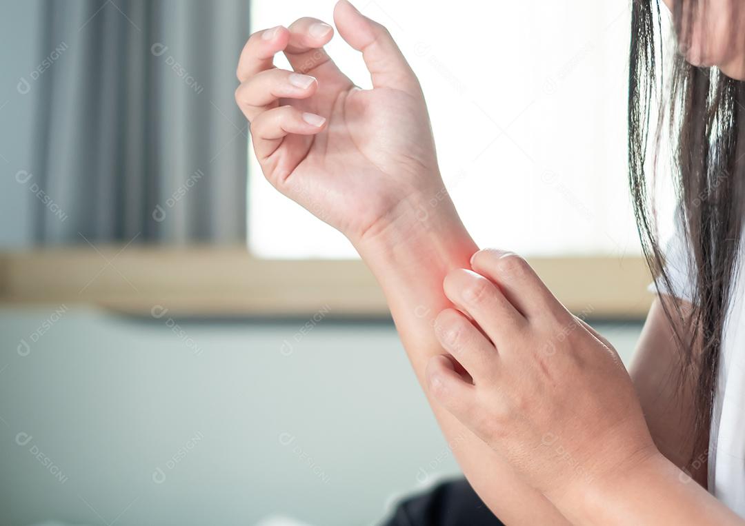 Feche no braço de uma mulher com coceira com a mão em casa, coceira devido a erupção cutânea, fungo, alergia, doença dermatológica, pele seca. Cuidados de saúde e conceito médico.