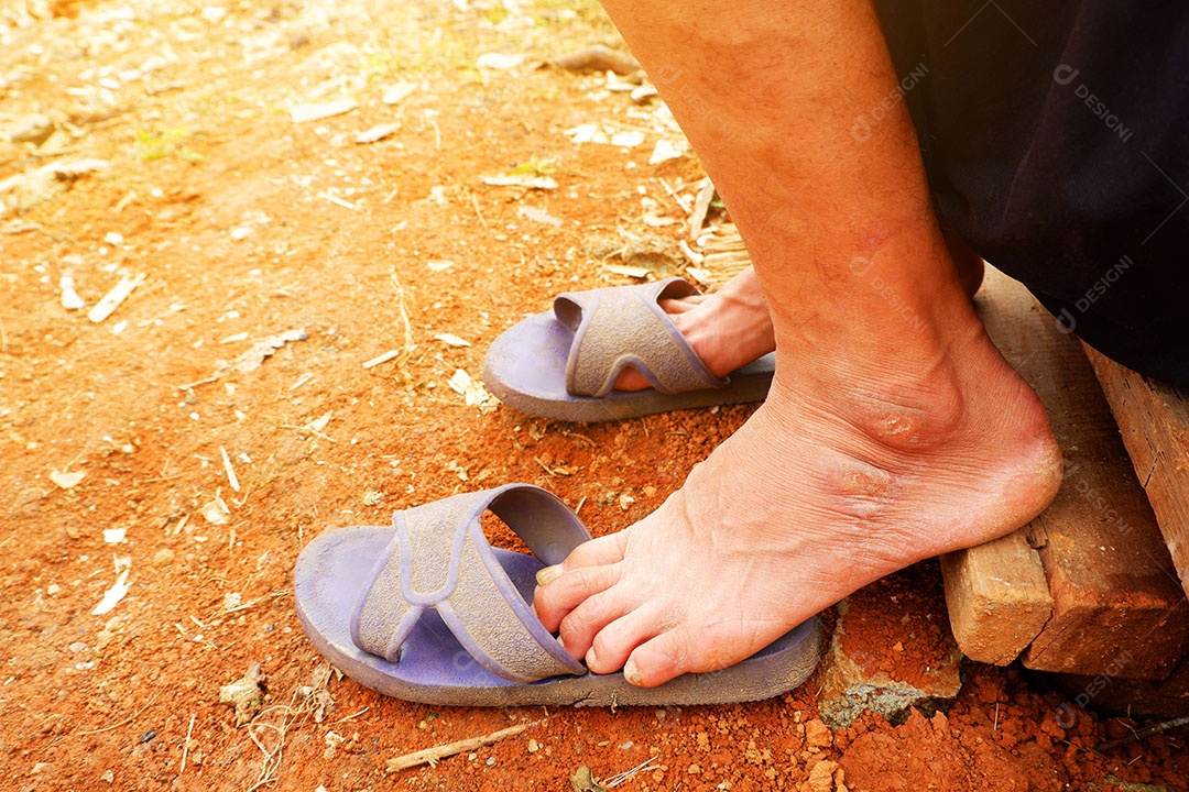 Tornozelo e calcanhar são endurecidos com pele quebrada do homem asiático