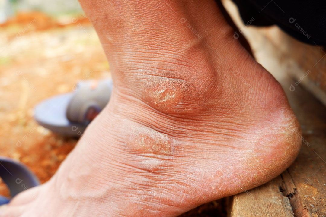 Tornozelo e calcanhar são endurecidos com pele quebrada do homem asiático