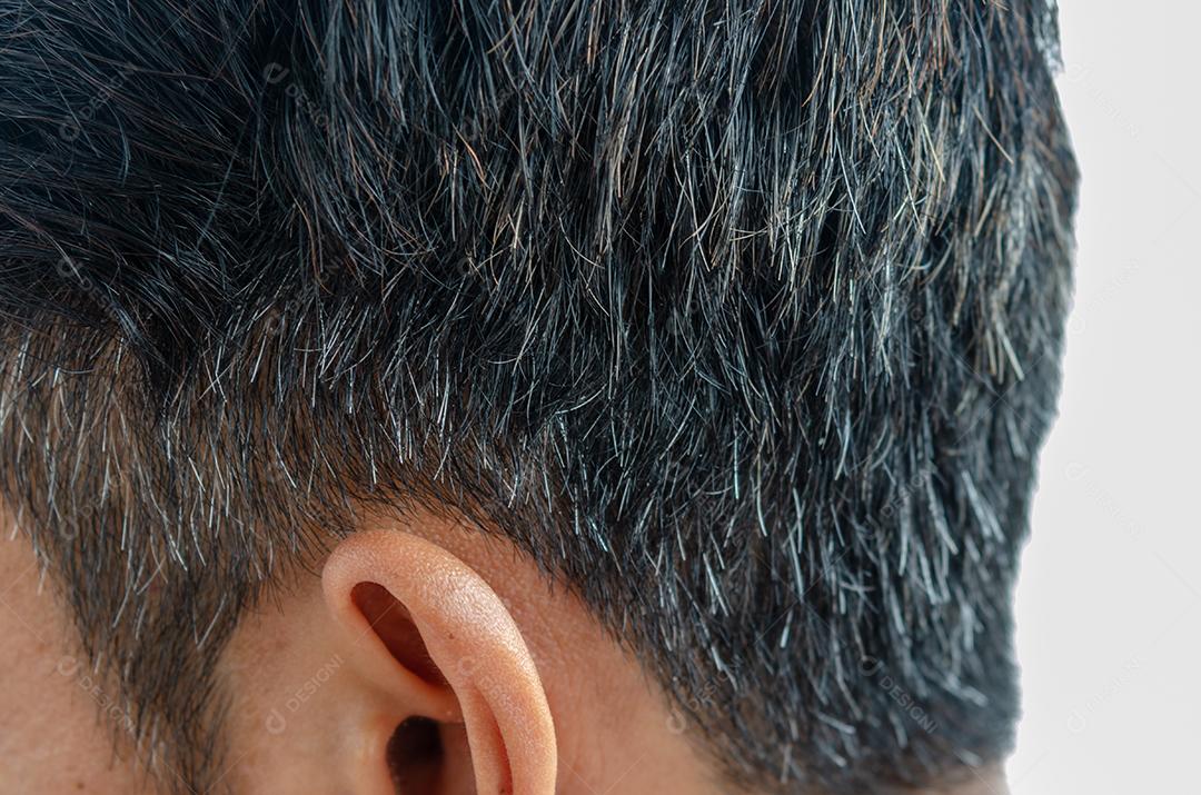 O cabelo branco perde cabelo em um jovem.