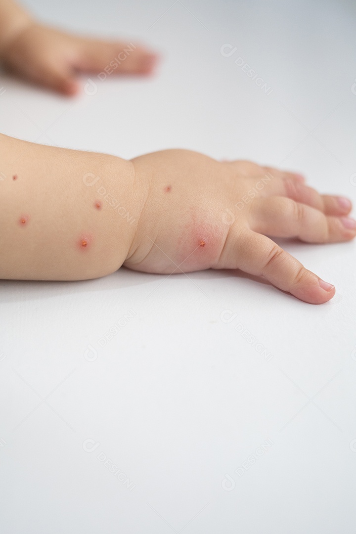 Pessoa picadas mosquito alergia Fotos Imagem JPG