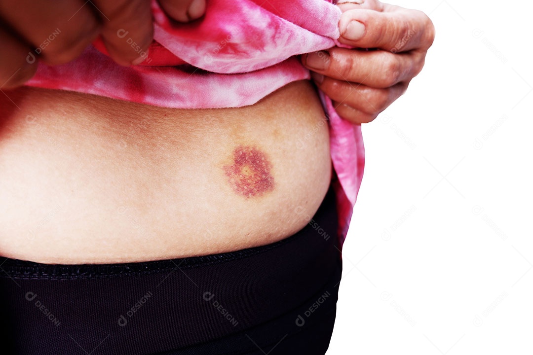 Hematomas na barriga de ser atingido por uma mulher gorda isolada no fundo branco
