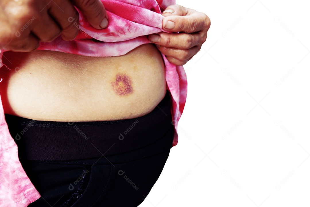 Hematomas na barriga de ser atingido por uma mulher gorda isolada no fundo branco