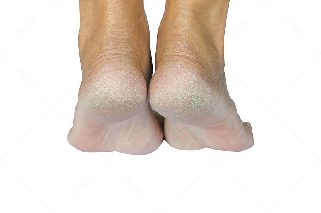 Pés rachados no fundo branco.