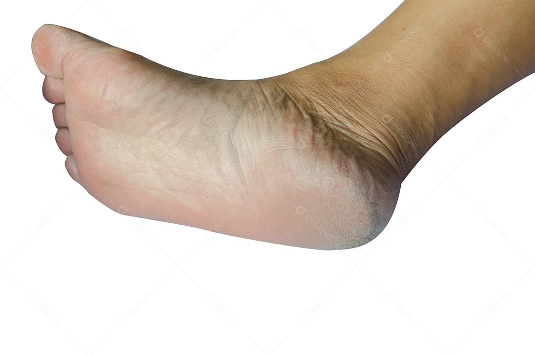 Pés rachados no fundo branco.