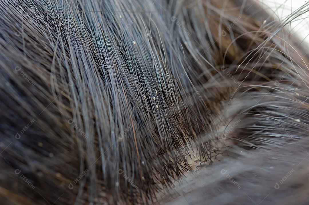 Ovo de piolho no cabelo causa coceira na cabeça.