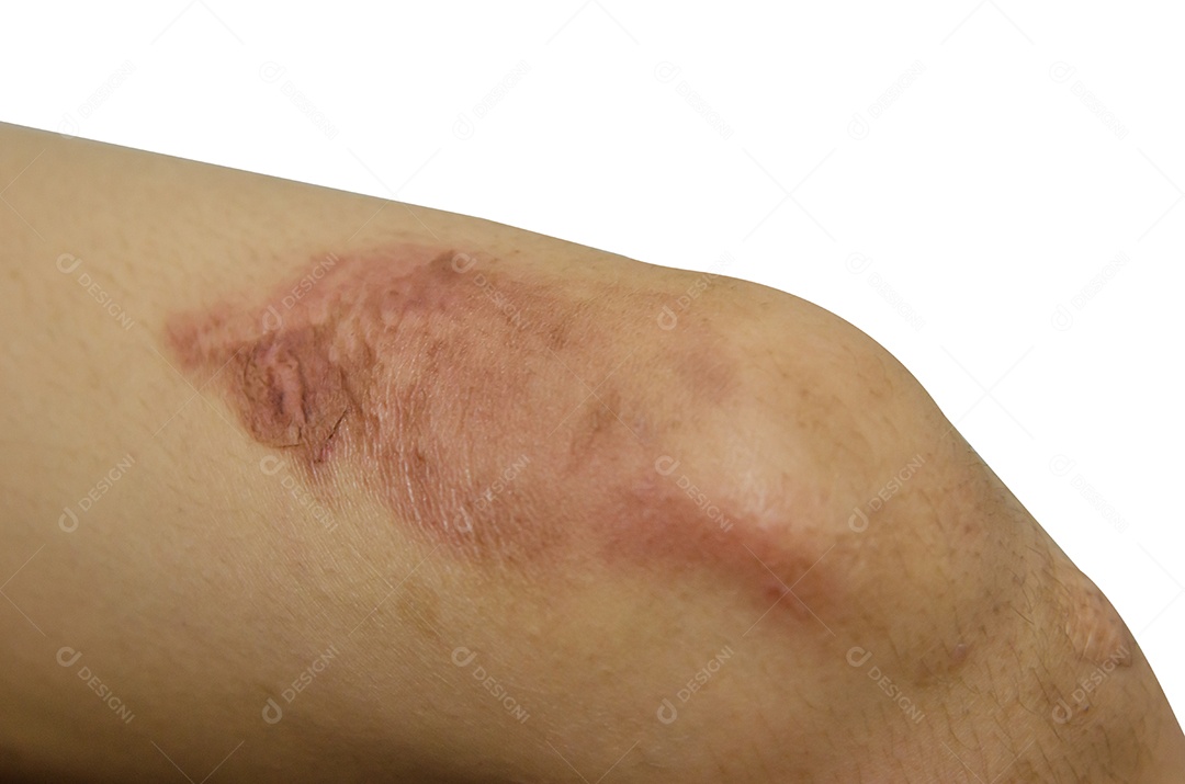 Escalde a perna isolada no fundo branco.