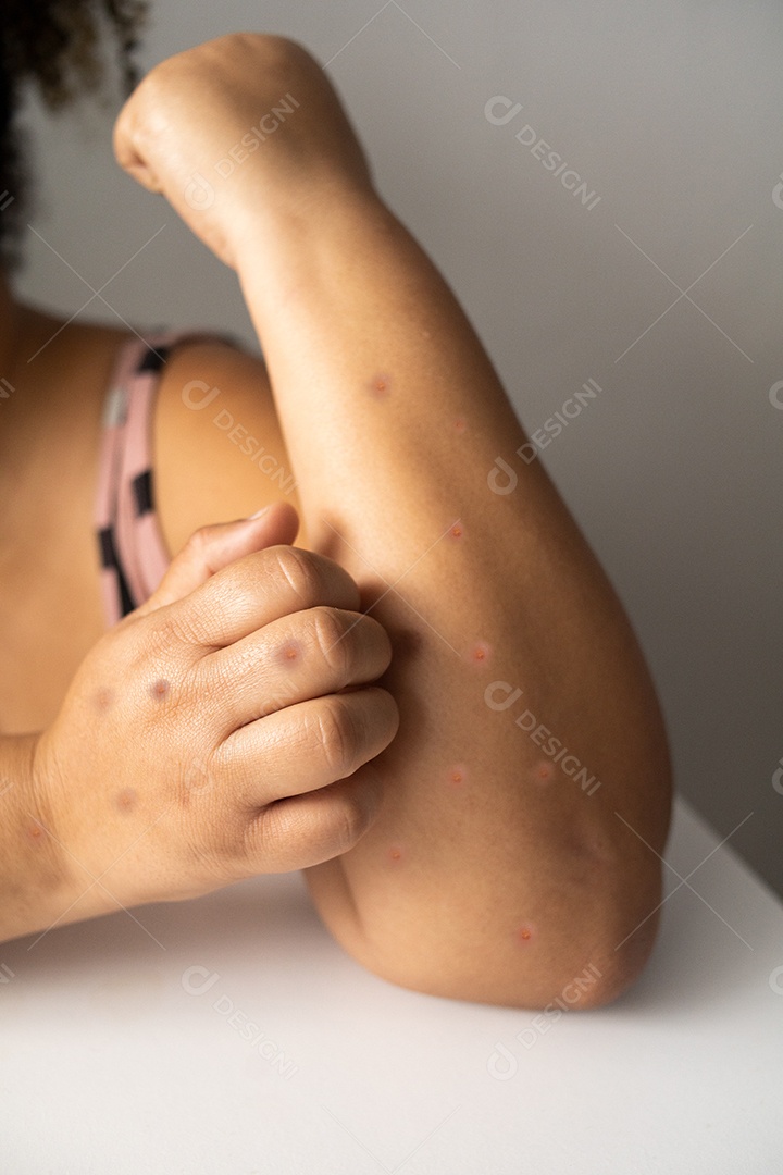 Pessoa mostrando picadas de mosquito alergia