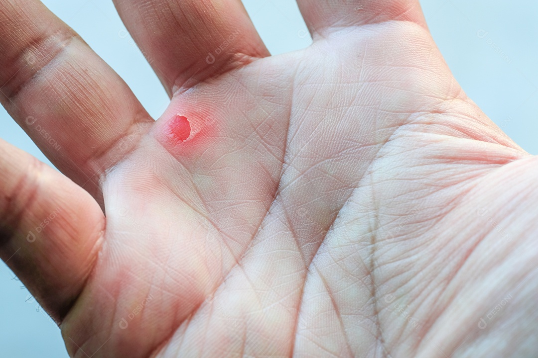 Feche a bolha disponível por excesso de trabalho, ferida na mão direita, macro