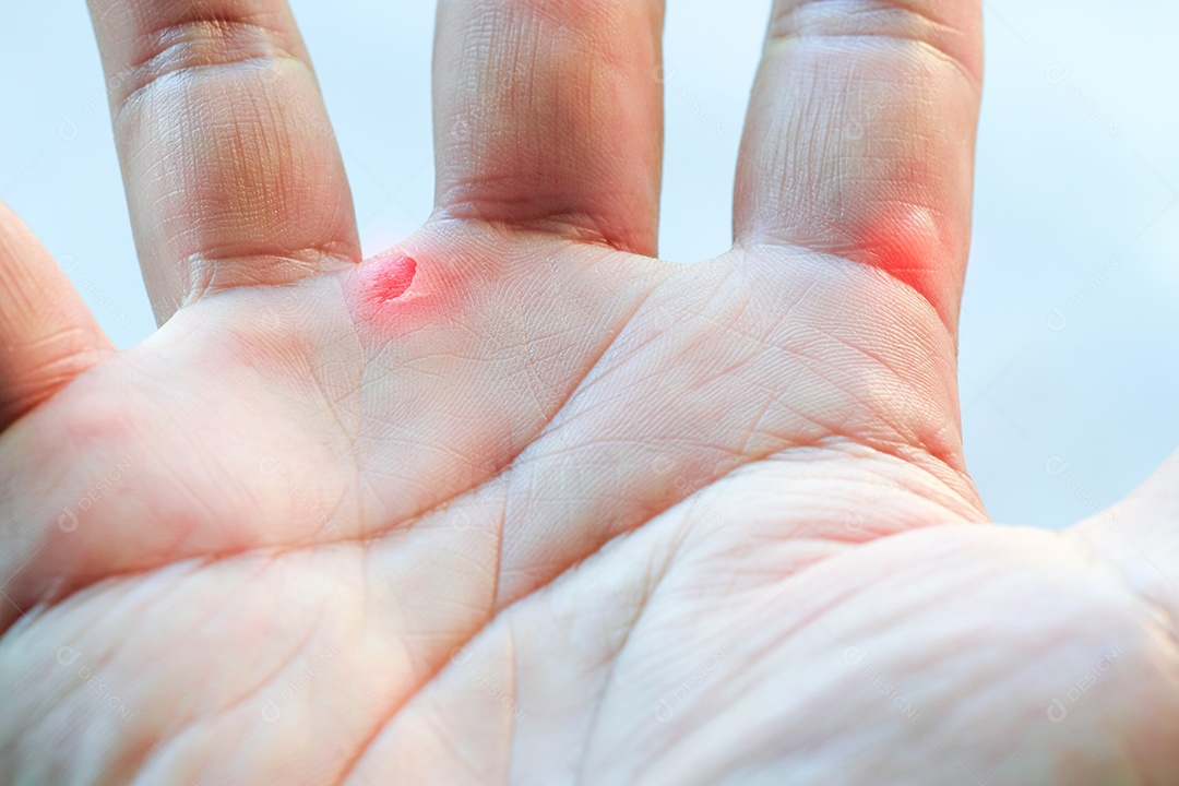 Feche a bolha disponível por excesso de trabalho, ferida na mão direita, macro