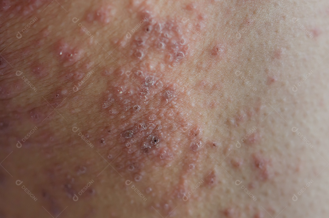 Close de erupções cutâneas causadas por alergias.