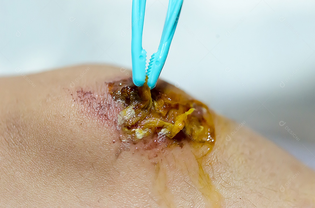 Limpando a ferida com algodão no joelho.