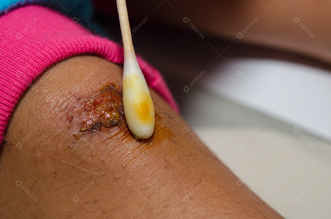 Limpando a ferida no joelho.