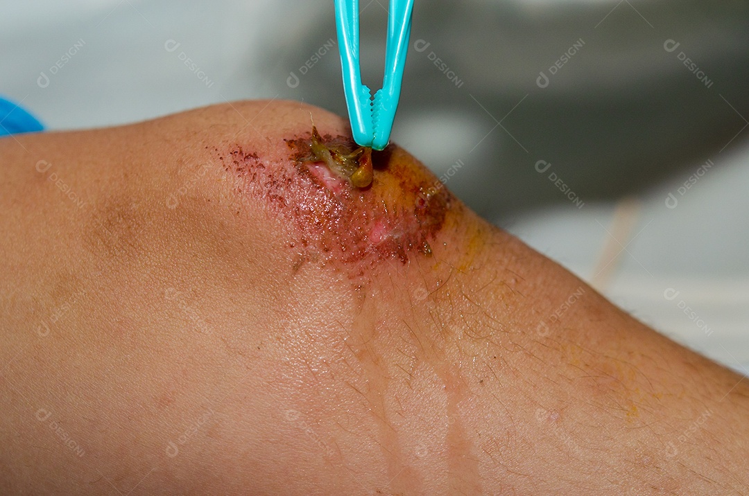 Limpando a ferida no joelho.