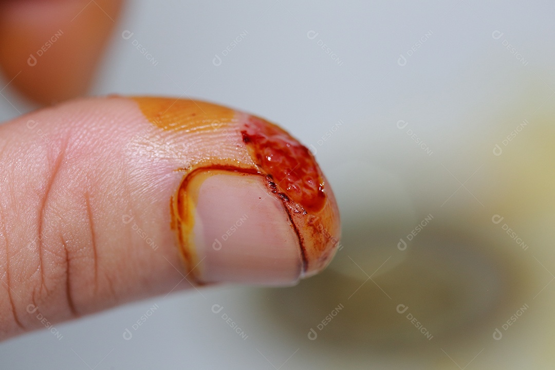 Close-up view of finger on human hand left thumb is cut injured.