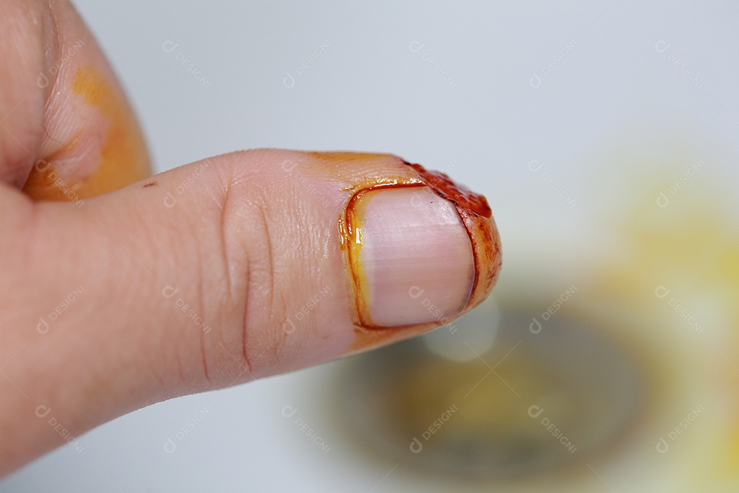 Close-up vista do dedo na mão humana do polegar esquerdo é cortado ferido.