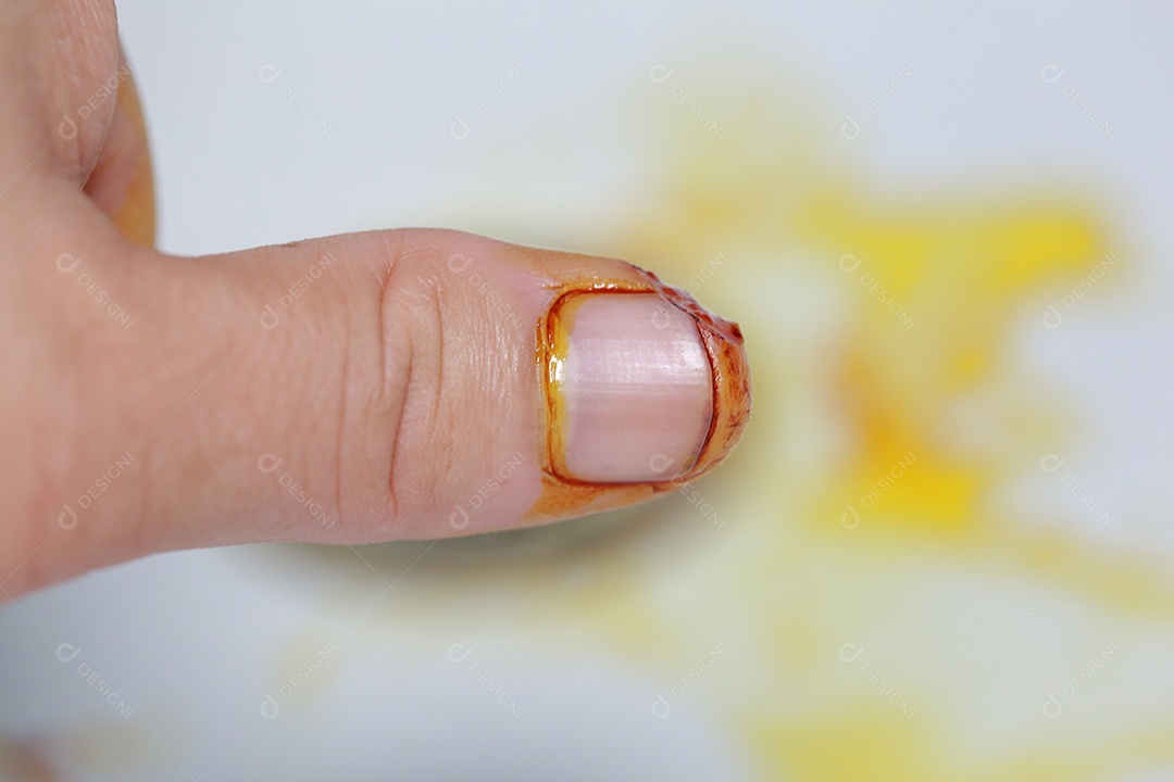 Close-up vista do dedo na mão humana do polegar esquerdo é cortado ferido.