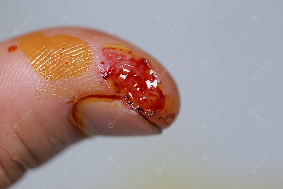 Close-up vista do dedo na mão humana do polegar esquerdo é cortado ferido.