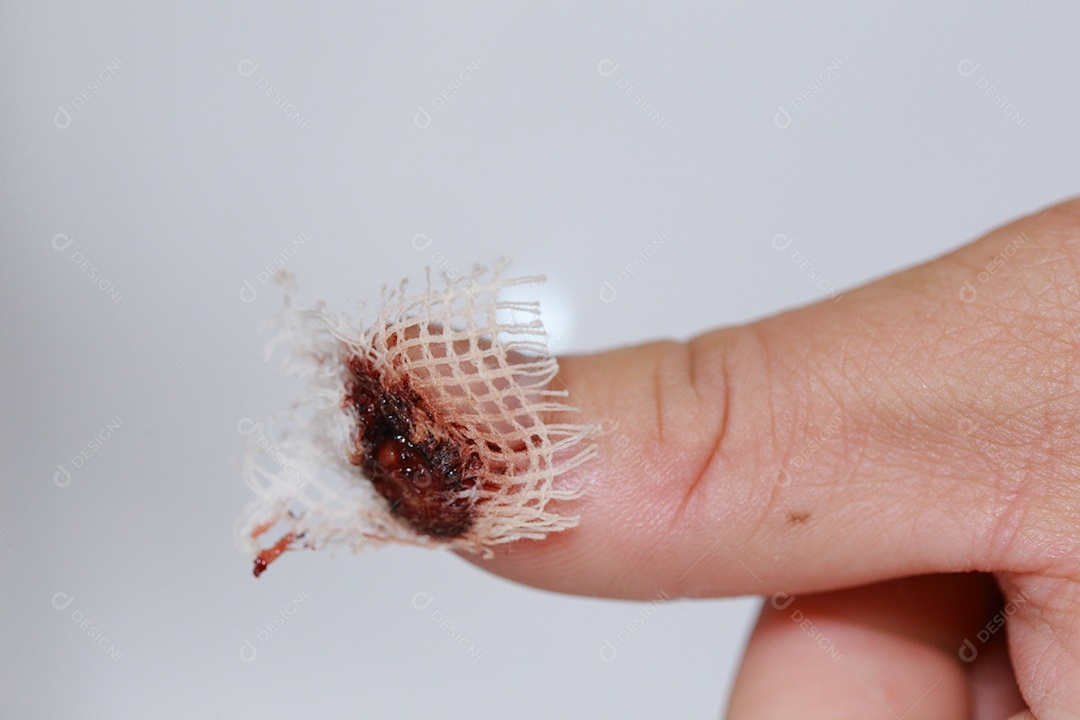 Close-up vista do dedo na mão humana do polegar esquerdo é cortado ferido.